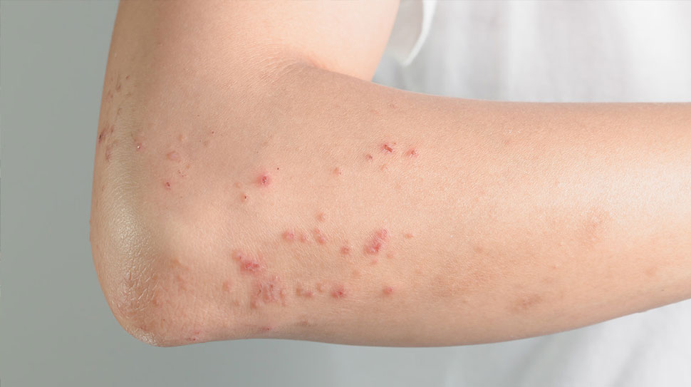 Türk dermatoloji profesörü Hulusi Behçet’in 1937 yılında tanımladığı Behçet hastalığı,